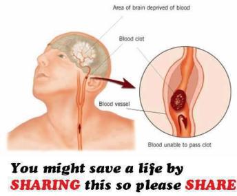 stroke-area-of-brain-deprived-of-blood-blood-ciot-blood-vessel-blood-unable-to-pass-ciot